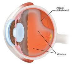 eye floaters treatment dc eye flashes