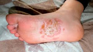 foot dyshidrotic eczema symptomore
