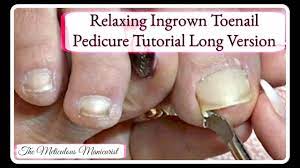 relaxing ingrown toenail removal big