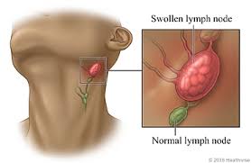 swollen lymph nodes care instructions
