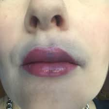 juvederm lip augmentation