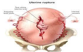rising uterine rupture endangers