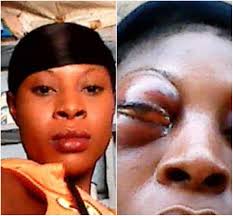 lady wakes up with a swollen eye