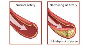 what is coronary artery disease and how