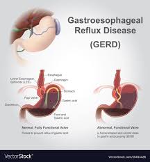 Gastro Reflux Disease Infographic