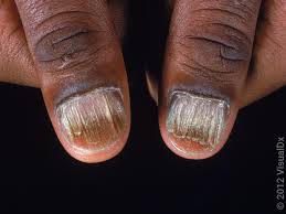 psoriatic arthritis affects the nails