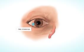 eye redness causes and treatments