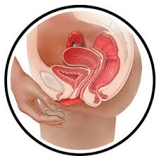 Image result for birth control vaginal ring