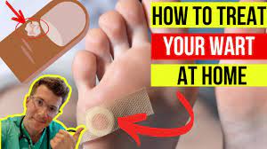 doctor explains how to treat warts at