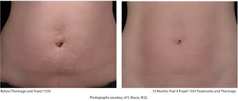 stretch mark removal laser treatments