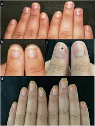 side effects of gel nail polish a