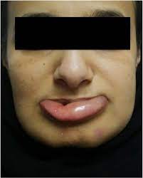 swelling of the lower lip and chin