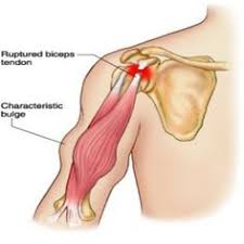 Image result for bicep tendon