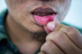 hiv mouth sores types of sores and
