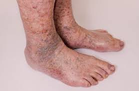 ankle discoloration what is stasis