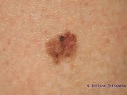 If you have skin cancer, it is important to know which type you have because it affects your treatment options and your outlook (prognosis). Skin Cancer And Pigmented Skin Lesions Ioulios Palamaras Md Phd