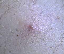 I have found a pea sized lump in my groin, between my legs / upper thigh. Ingrown Hair On Penile Shaft What It Looks Like And How To Remove
