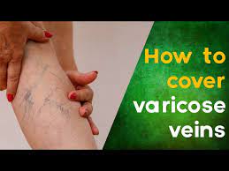 cover varicose veins