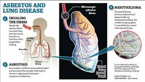 We defined the pleural cancer diagnosis date as the date of the first sdo reporting this condition. Asbestos Lung Disease Mesothelioma