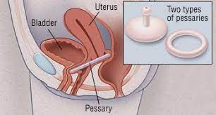 uterine and bladder prolapse guide
