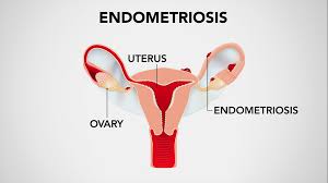 A disorder, typically leading to discomfort and dysmenorrhea, that's characterized by the abnormal event of useful endometrial muscle outside of the uterus.; Fibroids Endometriosis Pcos And Dyspareunia A Primer On These Common Reproductive Problems Cbc Life