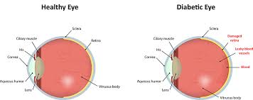 Diabetic Retinopathy Diagnosis Treatment Boston Eye Group