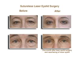 laser eyelid surgery bellevue stern
