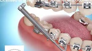 Rubber bands are fairly easy to put in with a little patience, but adjusting to them can take time. Types Of Appliances Edwards Schaefer Orthodontics Ann Arbor Mi