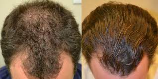 propecia for hair loss dr rogers new