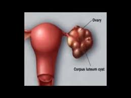 I have a large overian cyst 11 x 9 x 8 cm on one overy and on the other overy a 5cm one. Types Of Ovarian Cysts Types Of Ovarian Cysts And Tumours Youtube