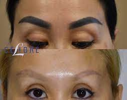 permanent makeup removal before after