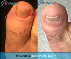 ingrown toenail surgery perth perth