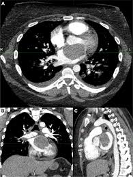 Benign conditions such as scarring or inflammation from prior infections. Malignant Pericardial Mesothelioma Treated Using Volumetric Modulated Arc Therapy With A Simultaneous Integrated Boost Advances In Radiation Oncology