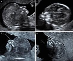 first trimester ultrasound evaluation