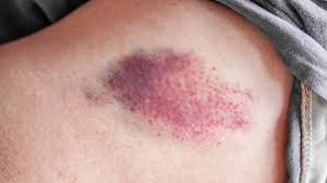 why do i bruise easily 8 reasons it