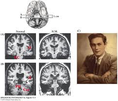 Examine one interaction between cognition and physiology in terms     Clive wearing suffered from an infection  biological factor  which affected  his memory and cognition 