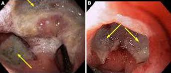 marginal ulcer arrows between gastric