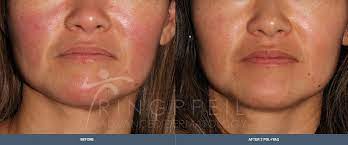 rosacea treatment philadelphia main