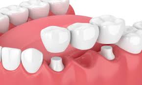 how much does a dental bridge cost