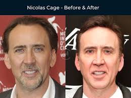 celebrity hair transplant in the world