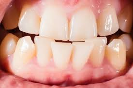 When your overbite is too large, your doctor might tell you you have a deep bite. Why Do I Need Braces On My Top And Bottom Teeth Labbe Family Orthodontics