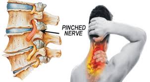 pinched nerve in neck arm shoulder