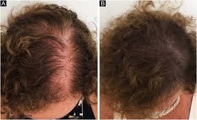 female pattern hair loss theutic