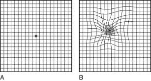 Amsler Grid An Overview Sciencedirect Topics