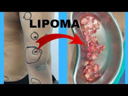 ranchi scarless lipoma removal lipoma