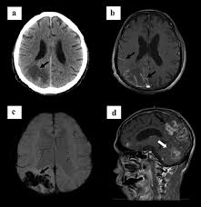 initial presentation ct brain scan