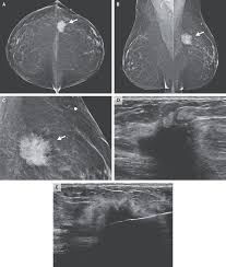 Asian woman feel bad and scratching her chest with skin problem. Case 22 2020 A 62 Year Old Woman With Early Breast Cancer During The Covid 19 Pandemic Nejm