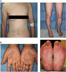 erythematous rash with purpura