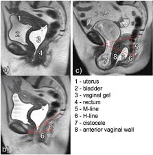 magnetic resonance imaging of the