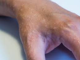 what is dyshidrotic eczema how to